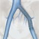 Zilver Venous Self Expanding Stent.jpg